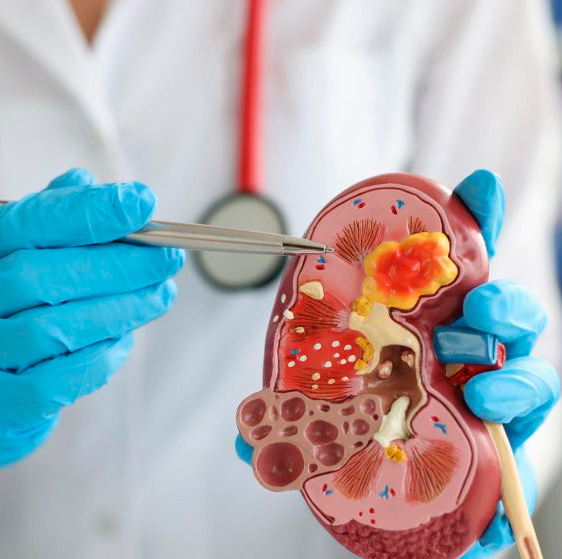 Ureteroscopia con láser para cálculos renales