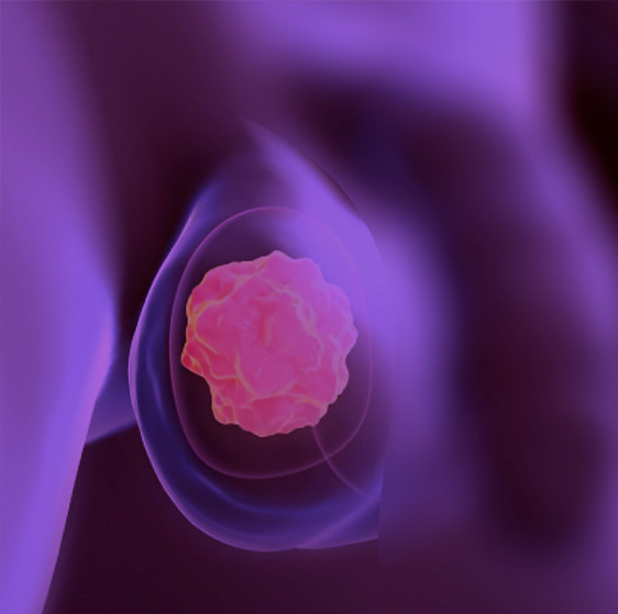 Cáncer de testículo — atención urológica oncológica en CDMX